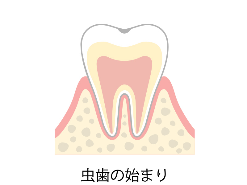 C0 虫歯のはじまり
