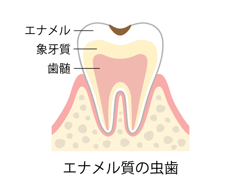 C1 エナメル質の虫歯