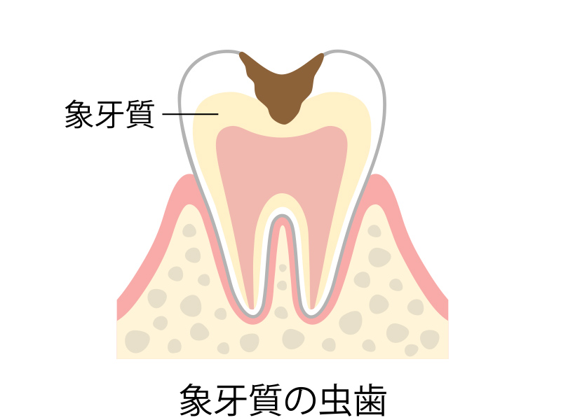 C2 象牙質の虫歯