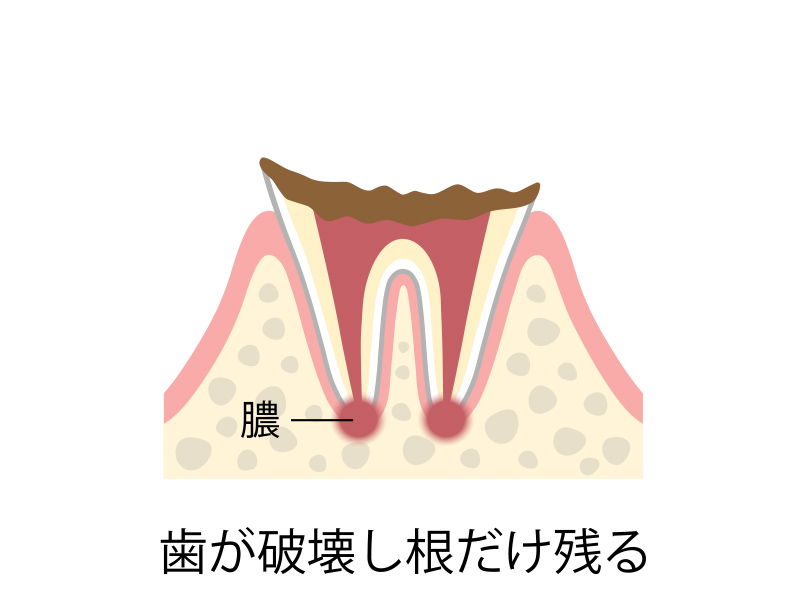 C4 歯根まで達した虫歯